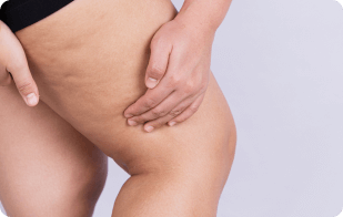 Lipedema